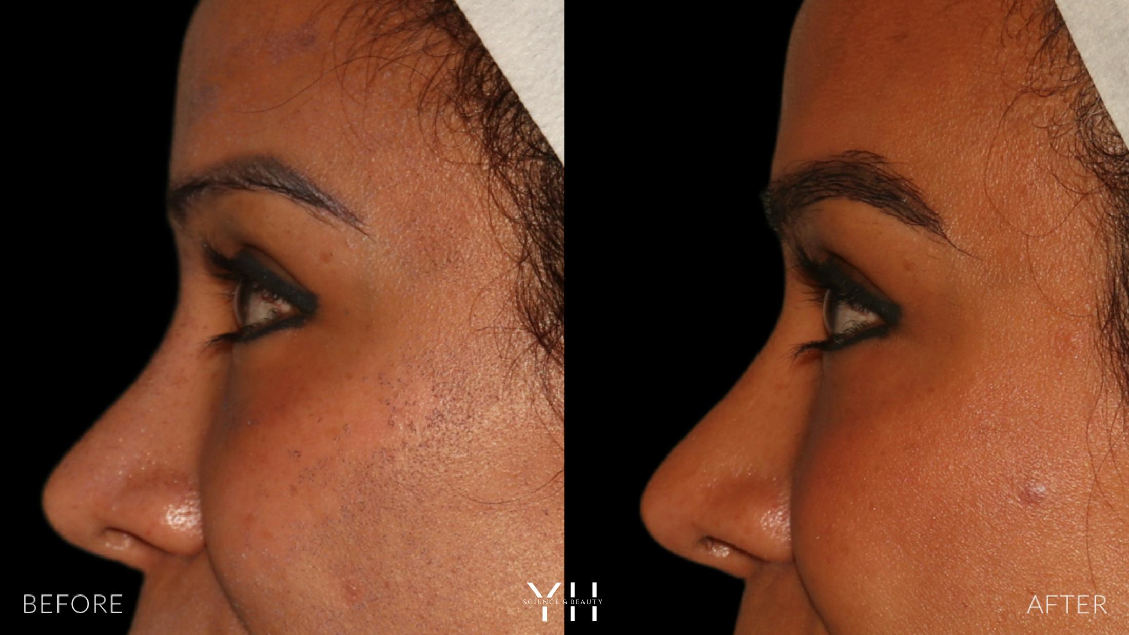 Eyebrow Transplant Before & After Gallery - Patient 375225 - Image 5