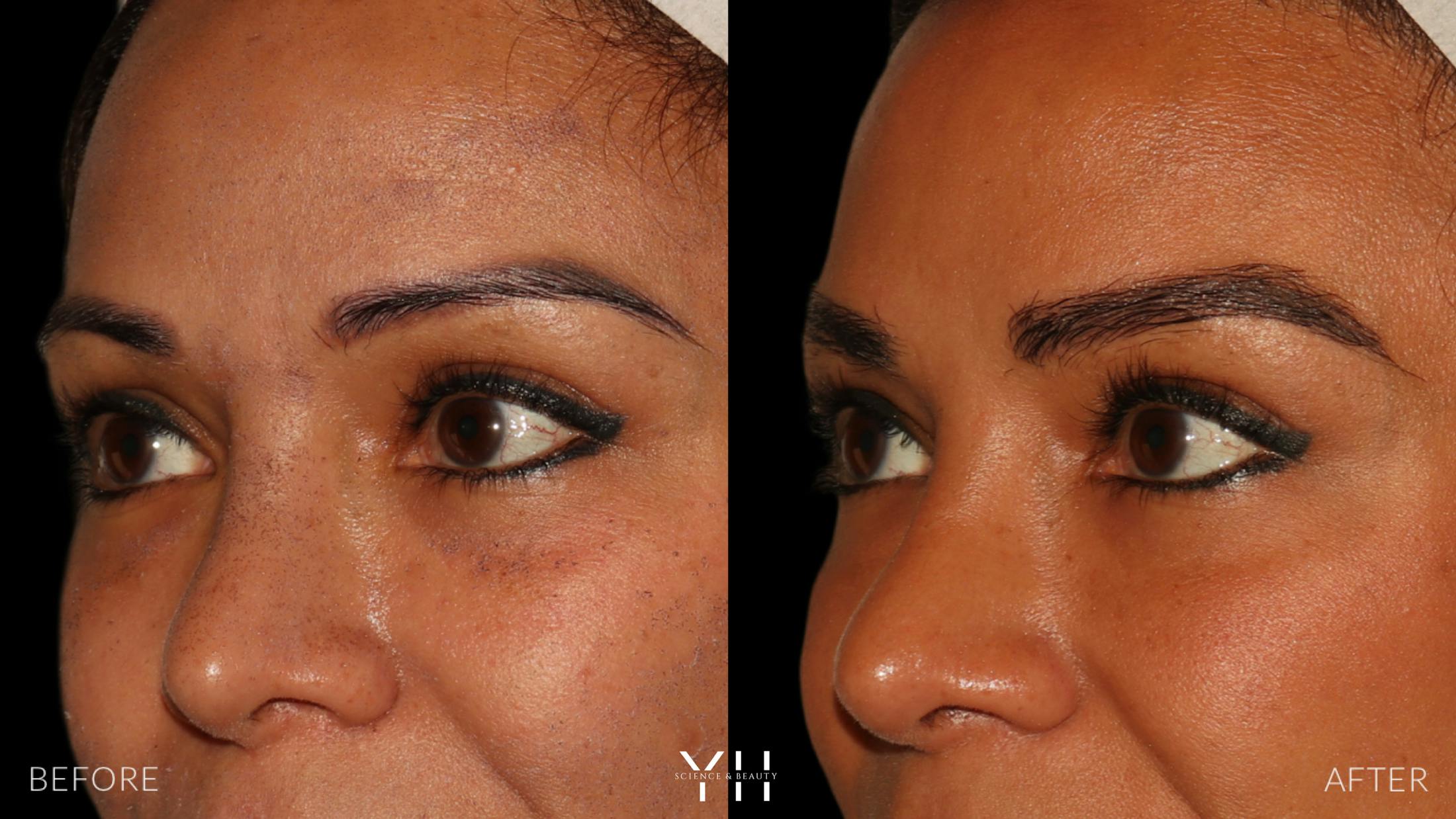 Eyebrow Transplant Before & After Gallery - Patient 375225 - Image 4