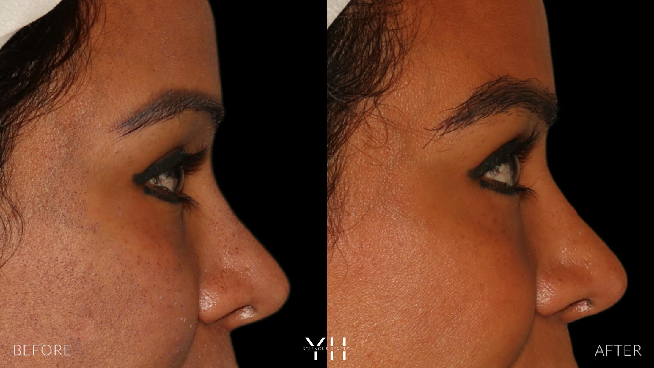 Eyebrow Transplant Before & After Gallery - Patient 375225 - Image 3