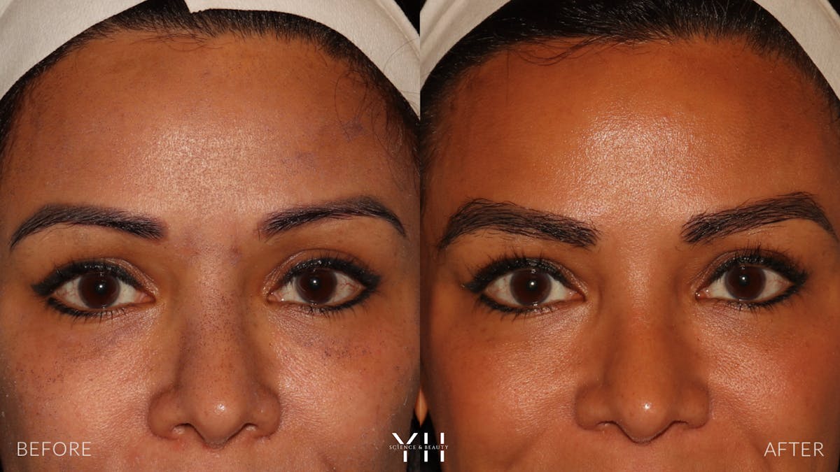 Eyebrow Transplant Before & After Gallery - Patient 375225 - Image 1