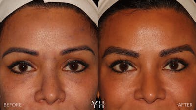 Eyebrow Transplant Before & After Gallery - Patient 375225 - Image 1
