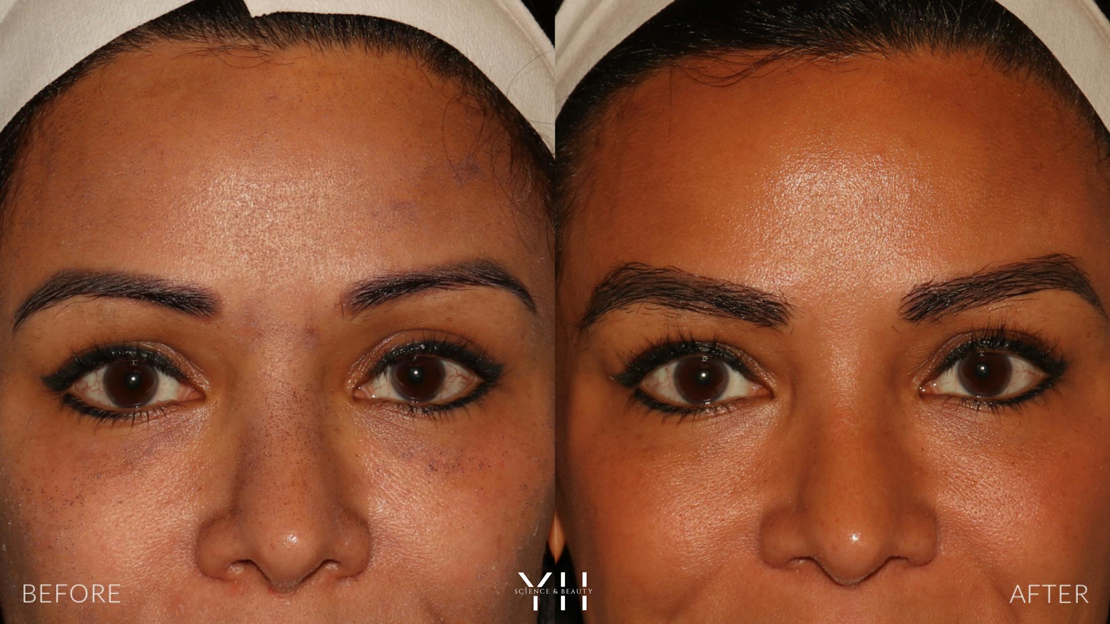 Eyebrow Transplant Before & After Gallery - Patient 375225 - Image 1