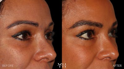 Eyebrow Transplant Before & After Gallery - Patient 375225 - Image 2