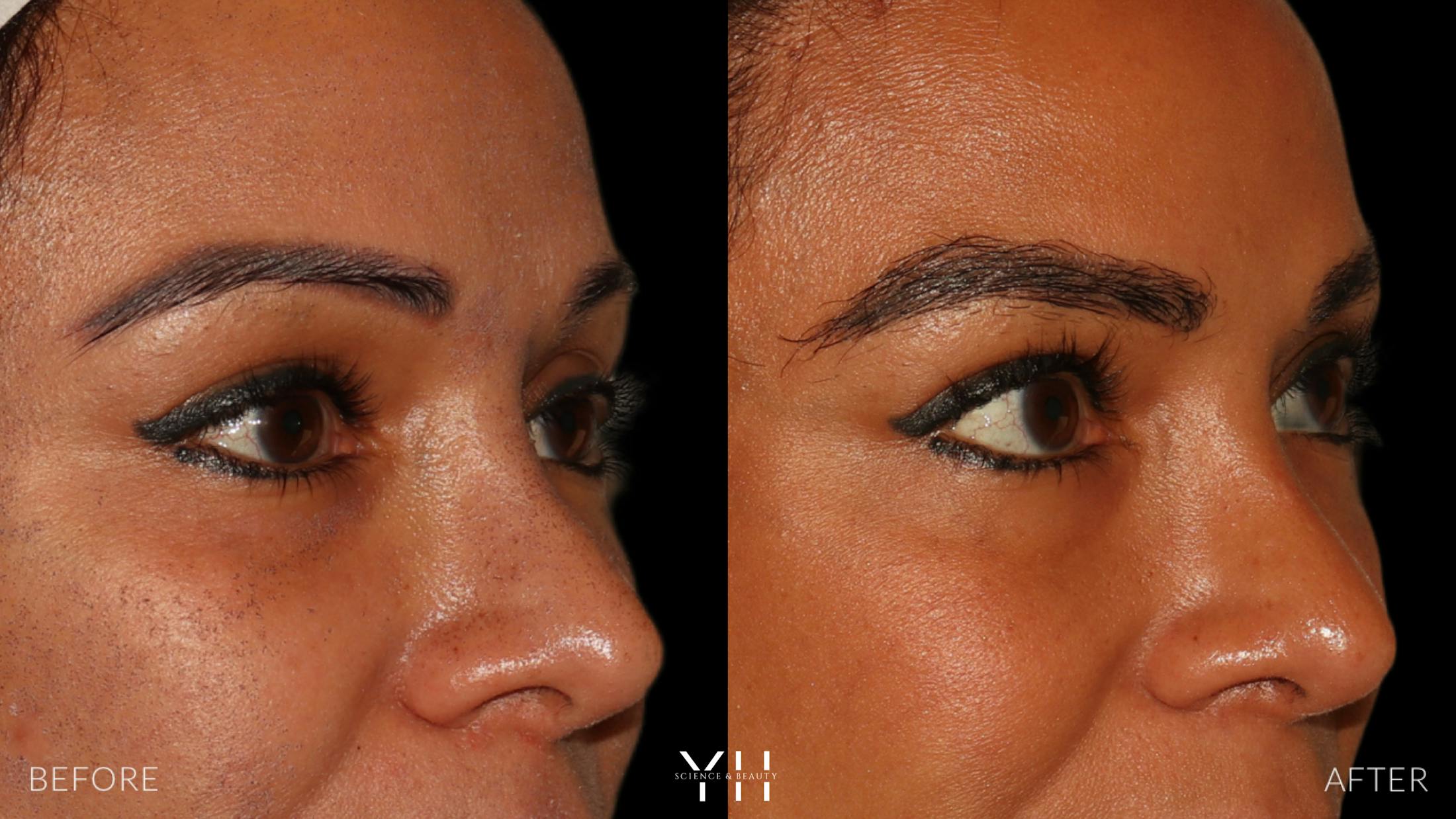 Eyebrow Transplant Before & After Gallery - Patient 375225 - Image 2