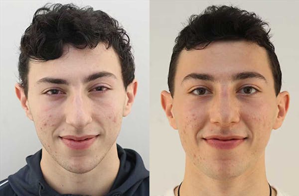 Rhinoplasty Before & After Gallery - Patient 54185055 - Image 2