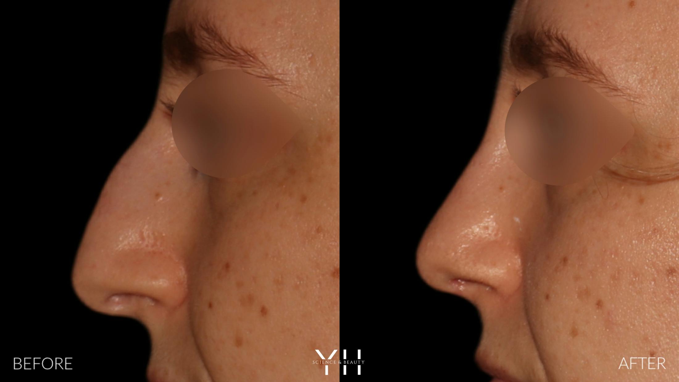 Rhinoplasty Before & After Gallery - Patient 177237 - Image 5