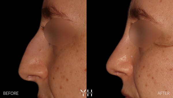 Rhinoplasty Before & After Gallery - Patient 177237 - Image 5