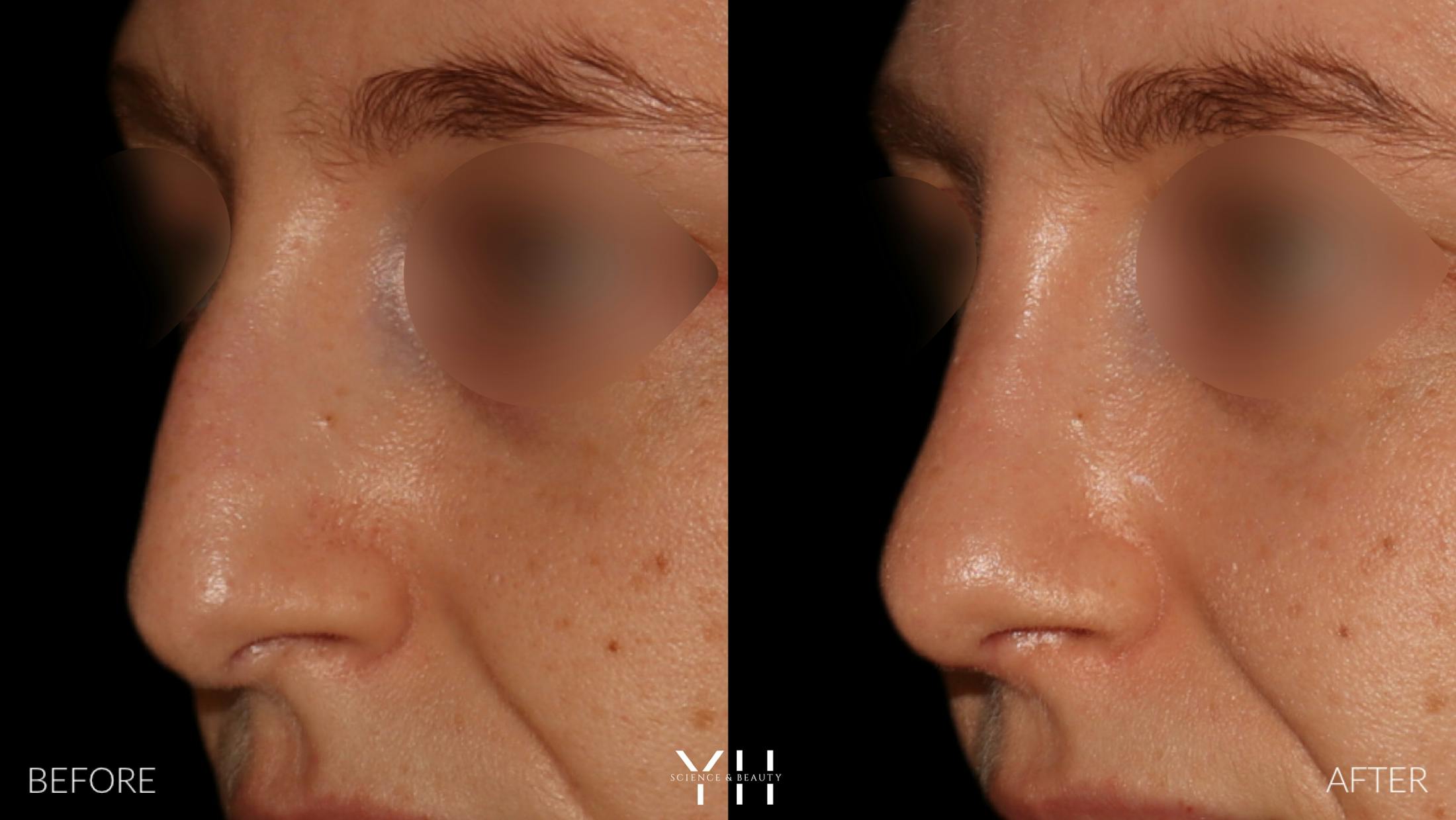 Rhinoplasty Before & After Gallery - Patient 177237 - Image 4