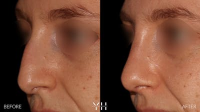 Rhinoplasty Before & After Gallery - Patient 177237 - Image 4