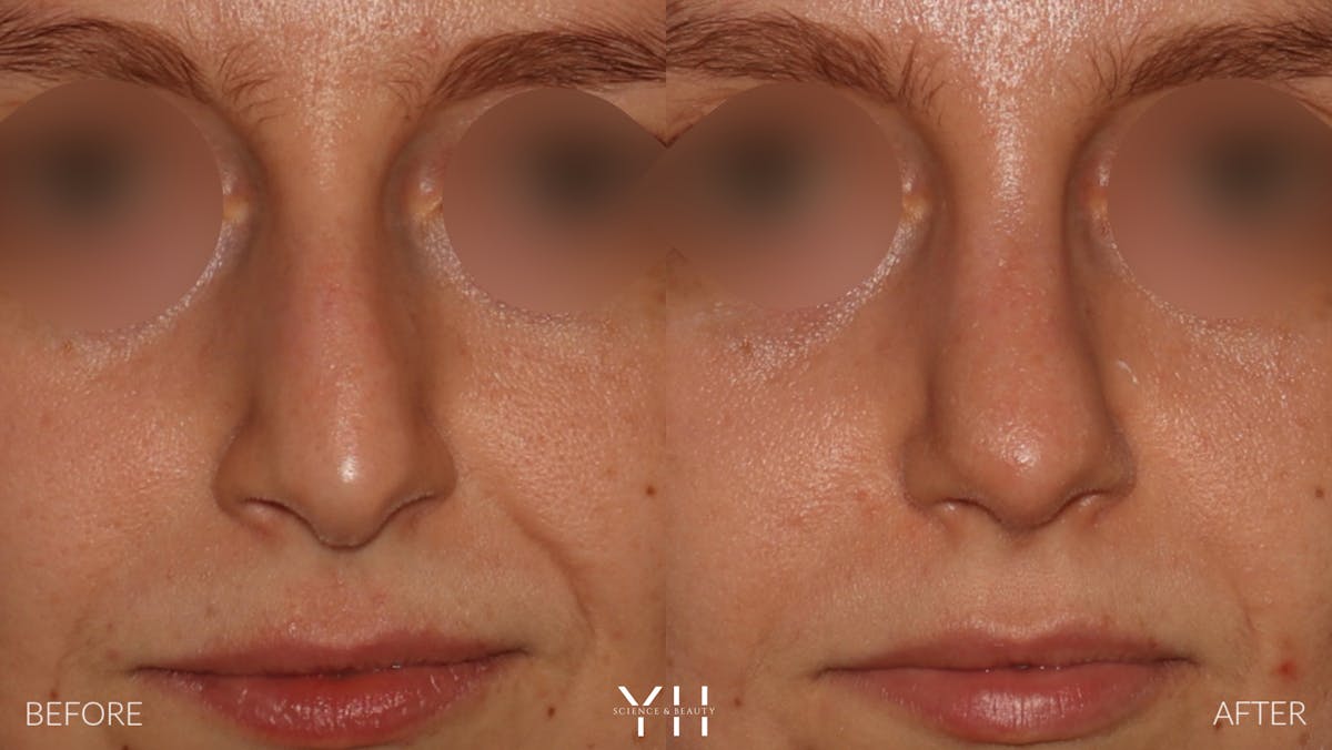 Rhinoplasty Before & After Gallery - Patient 177237 - Image 3