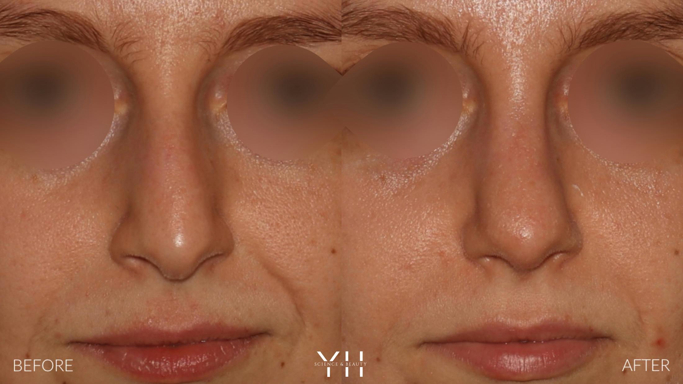 Rhinoplasty Before & After Gallery - Patient 177237 - Image 3