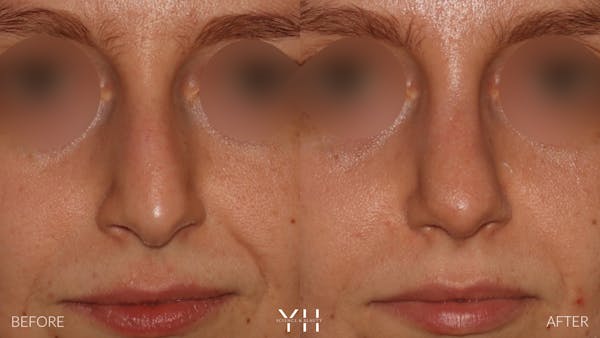 Rhinoplasty Before & After Gallery - Patient 177237 - Image 3