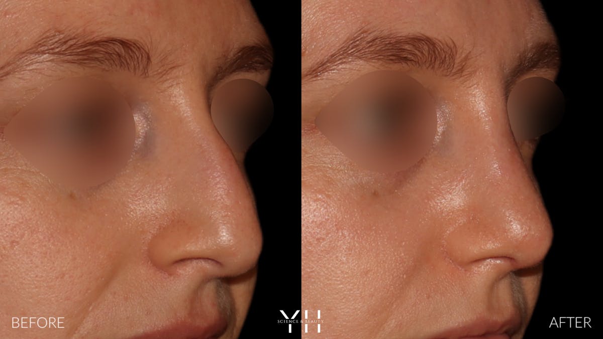 Rhinoplasty Before & After Gallery - Patient 177237 - Image 2