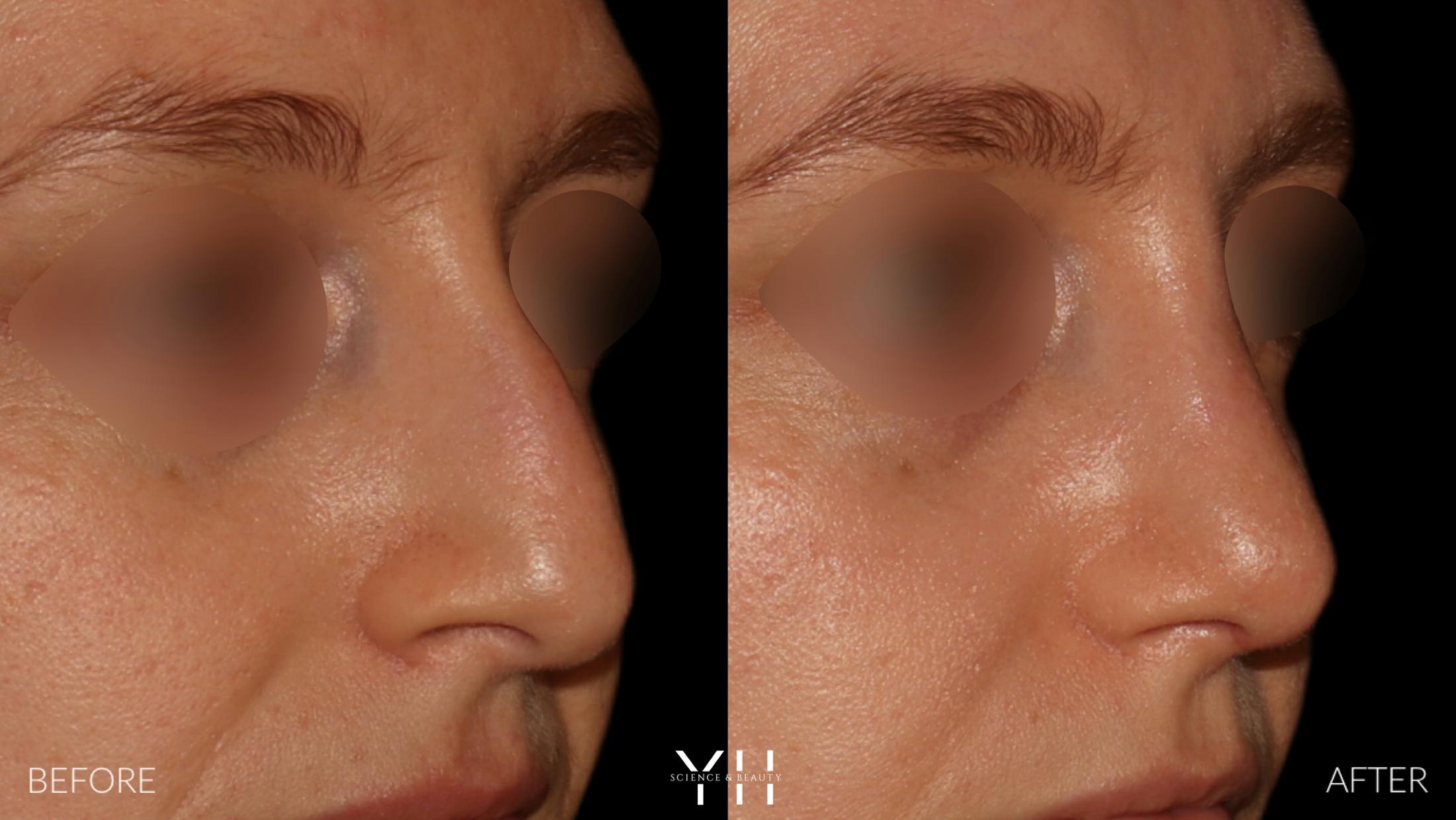 Rhinoplasty Before & After Gallery - Patient 177237 - Image 2
