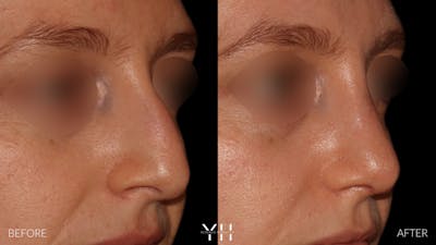 Rhinoplasty Before & After Gallery - Patient 177237 - Image 2