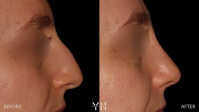 Rhinoplasty Before & After Gallery - Patient 177237 - Image 1