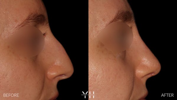 Rhinoplasty Before & After Gallery - Patient 177237 - Image 1