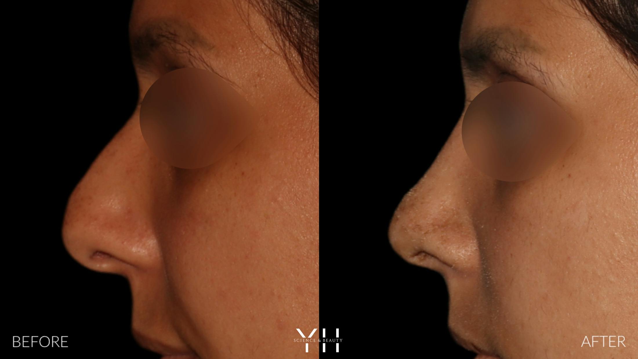 Rhinoplasty Before & After Gallery - Patient 182696 - Image 5