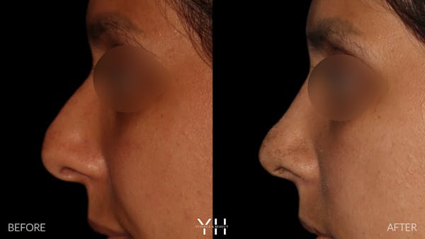 Rhinoplasty Before & After Gallery - Patient 182696 - Image 5