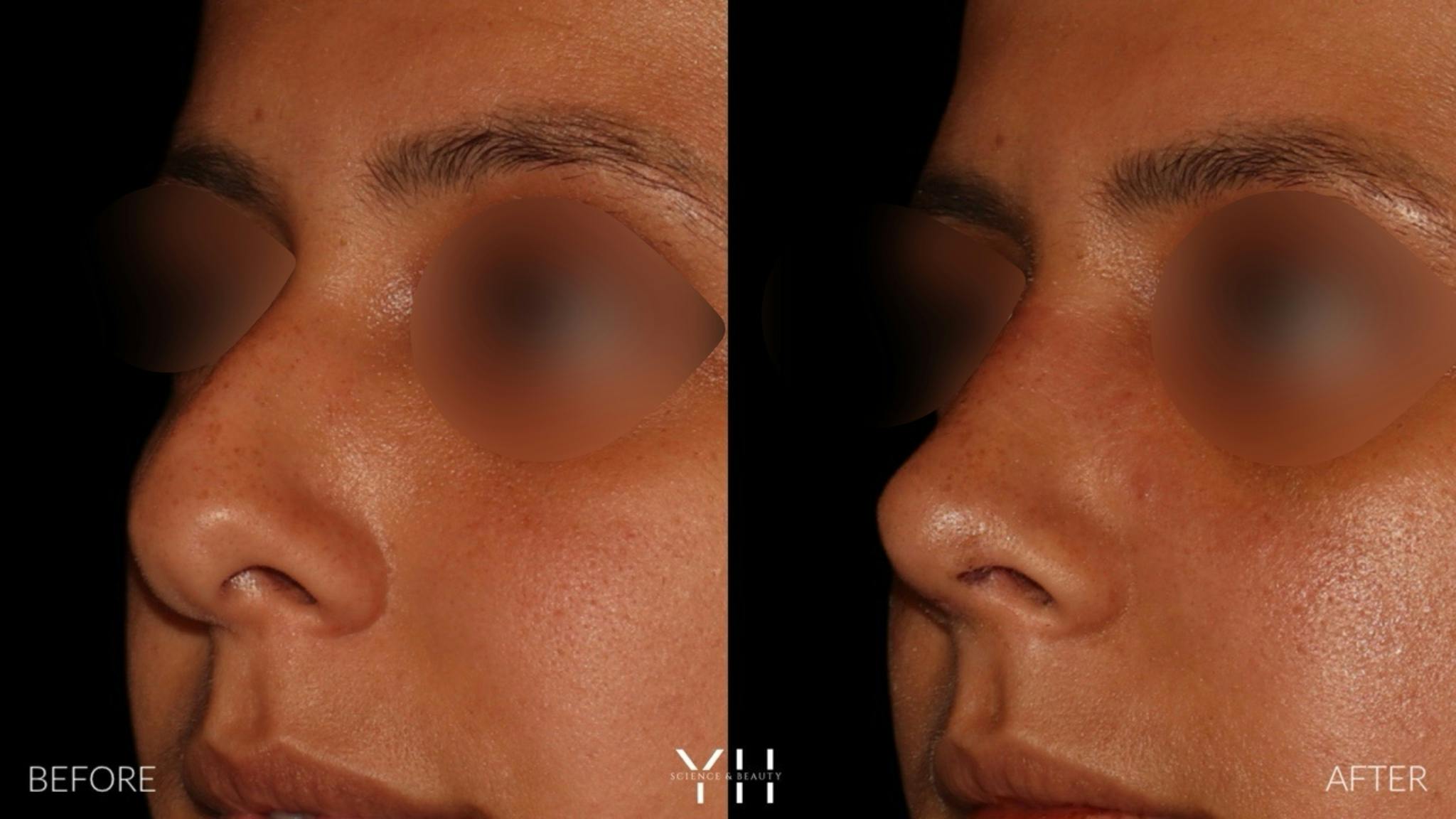 Rhinoplasty Before & After Gallery - Patient 182696 - Image 4