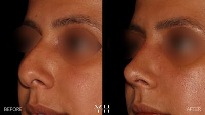 Rhinoplasty Before & After Gallery - Patient 182696 - Image 4