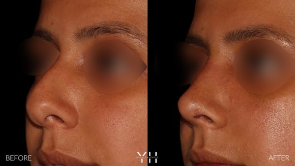 Rhinoplasty Before & After Gallery - Patient 182696 - Image 4