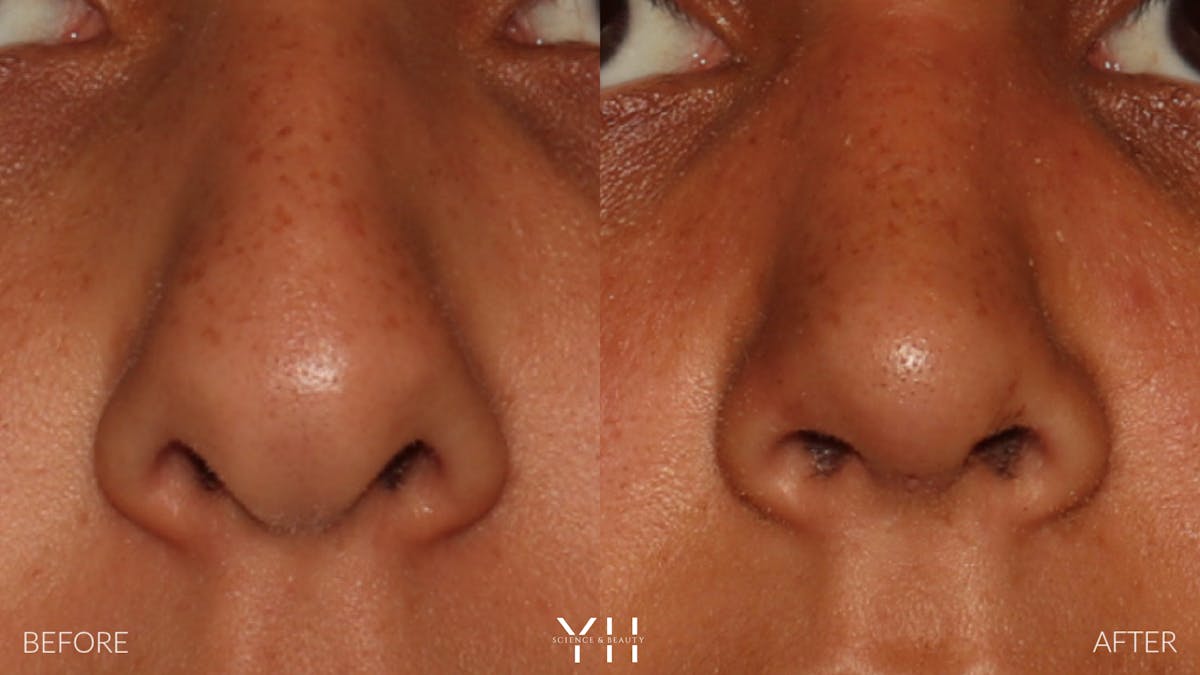 Rhinoplasty Before & After Gallery - Patient 182696 - Image 3