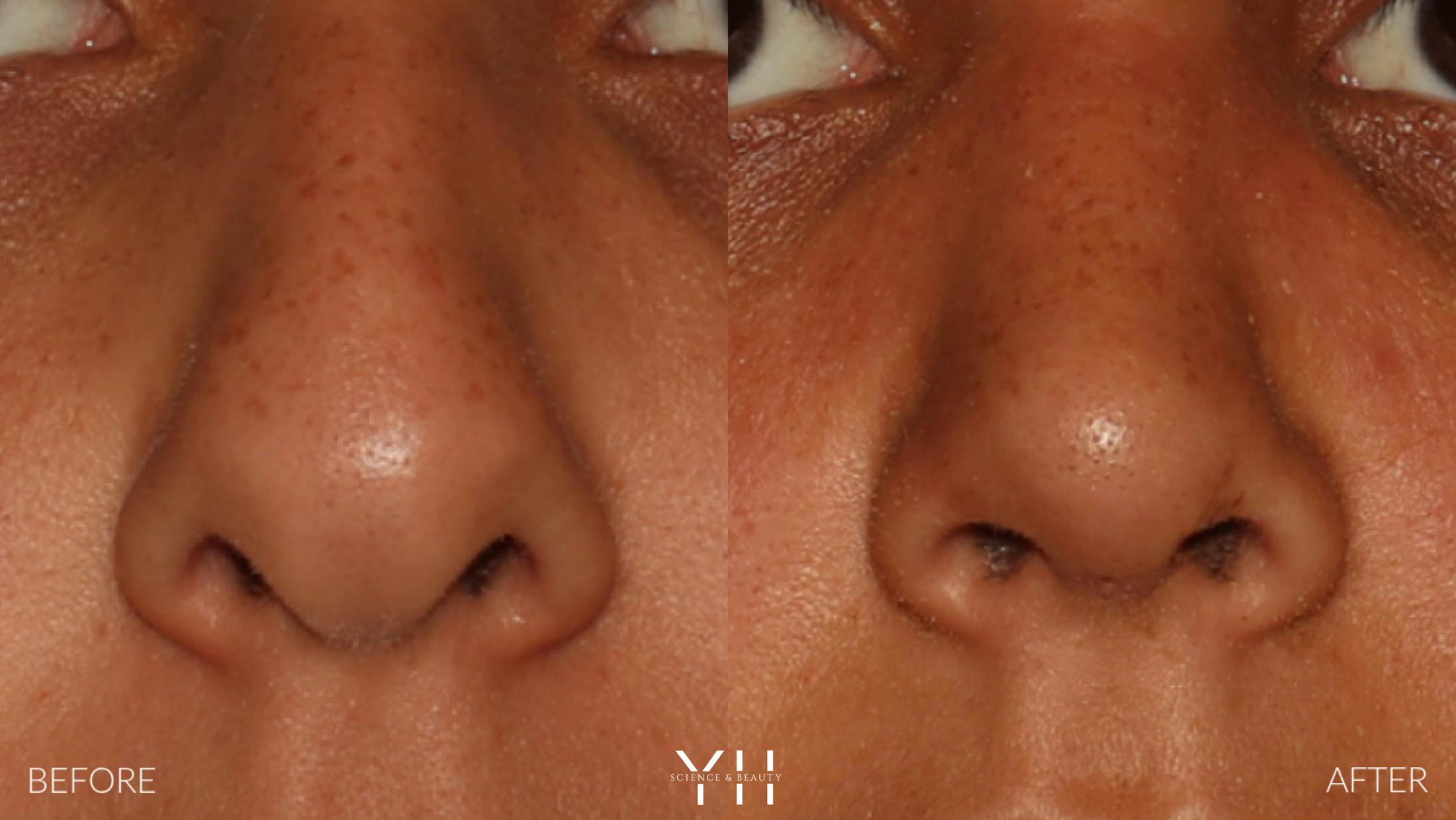 Rhinoplasty Before & After Gallery - Patient 182696 - Image 3