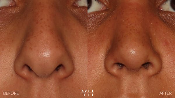 Rhinoplasty Before & After Gallery - Patient 182696 - Image 3