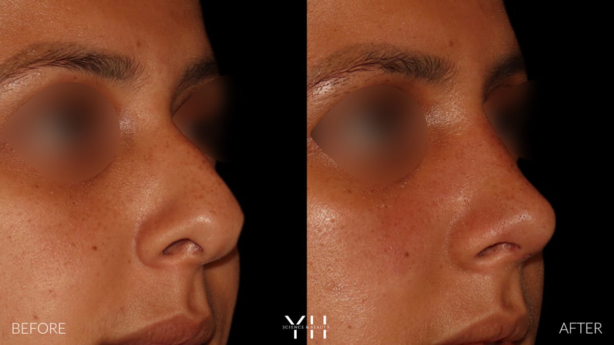 Rhinoplasty Before & After Gallery - Patient 182696 - Image 2