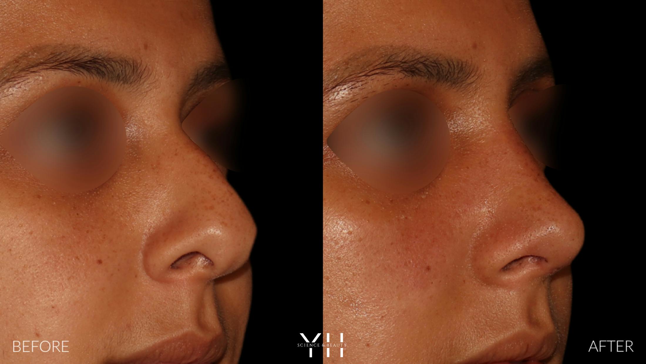 Rhinoplasty Before & After Gallery - Patient 182696 - Image 2