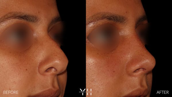 Rhinoplasty Before & After Gallery - Patient 182696 - Image 2