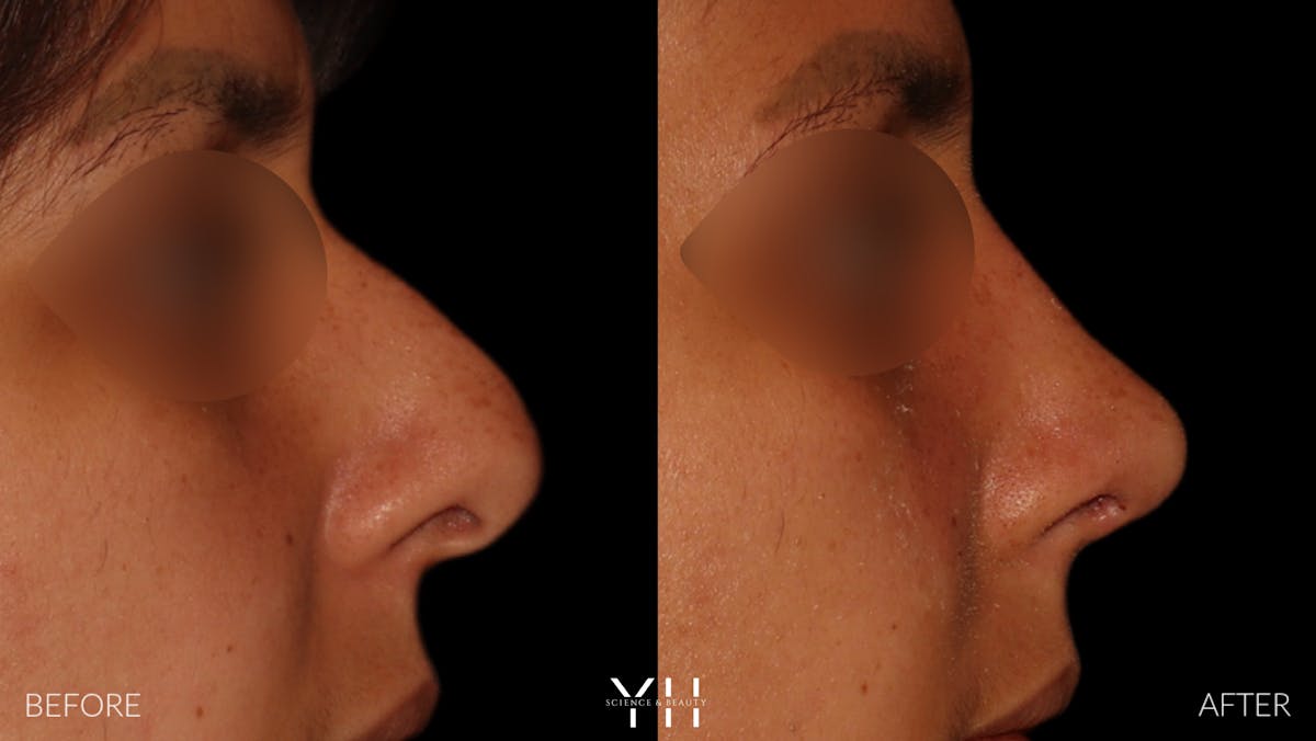 Rhinoplasty Before & After Gallery - Patient 182696 - Image 1