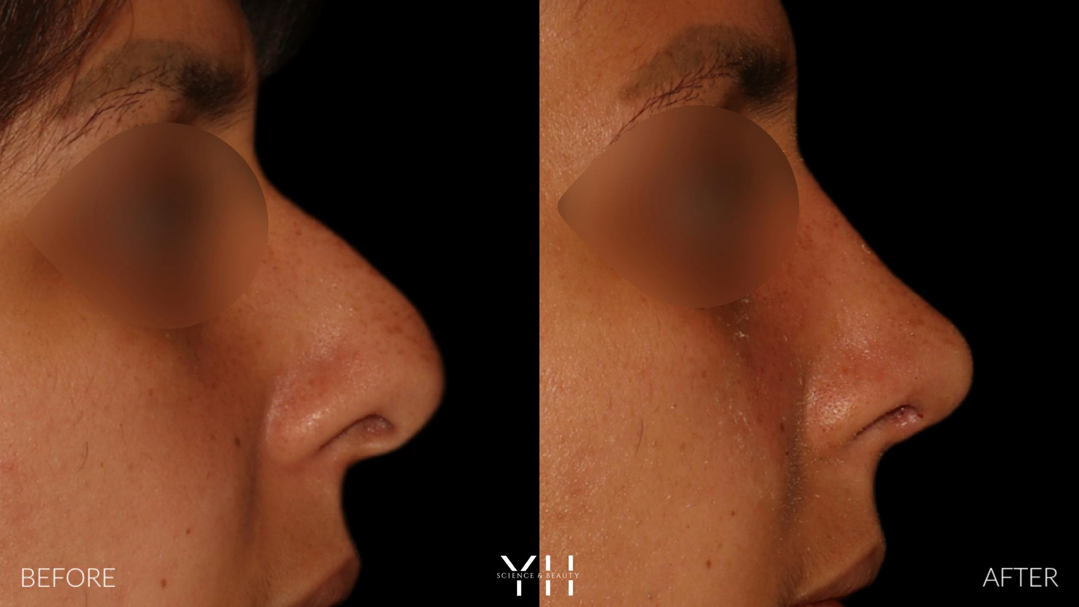 Rhinoplasty Before & After Gallery - Patient 182696 - Image 1
