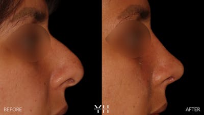 Rhinoplasty Before & After Gallery - Patient 182696 - Image 1