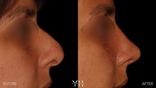 Rhinoplasty Before & After Gallery - Patient 182696 - Image 1