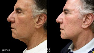 Necklift Before & After Gallery - Patient 145221 - Image 1