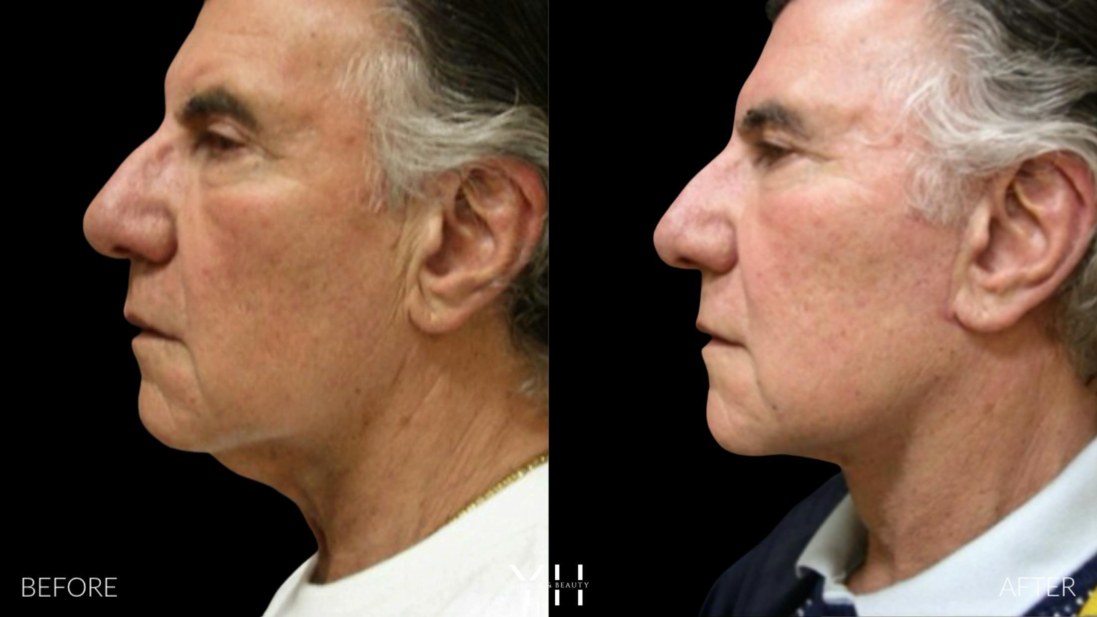 Necklift Before & After Gallery - Patient 145221 - Image 1