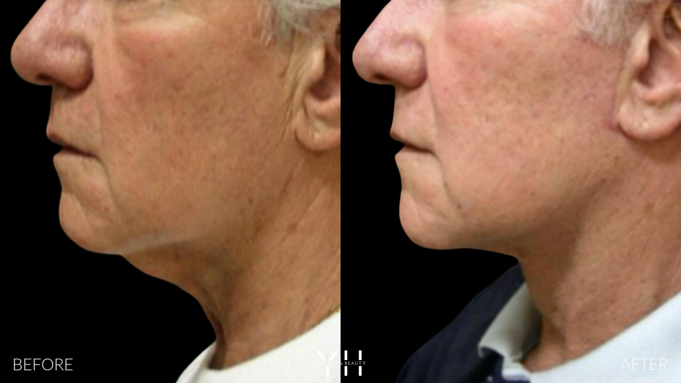 Necklift Before & After Gallery - Patient 145221 - Image 2