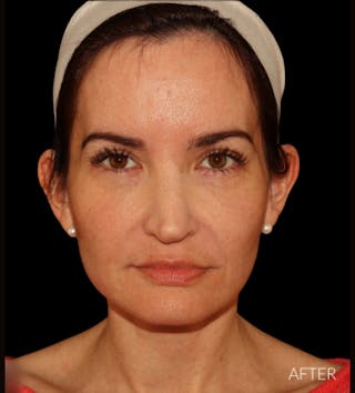 Facelift Before & After Gallery - Patient 121763167 - Image 2
