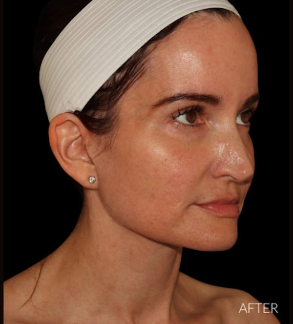 Facelift Before & After Gallery - Patient 121763167 - Image 8