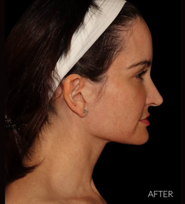 Facelift Before & After Gallery - Patient 121763167 - Image 4