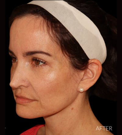 Facelift Before & After Gallery - Patient 121763167 - Image 6