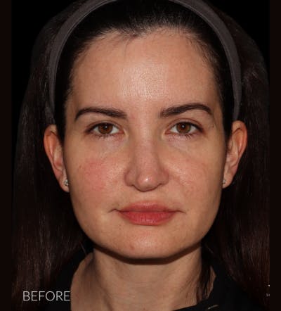 Facelift Before & After Gallery - Patient 121763167 - Image 1