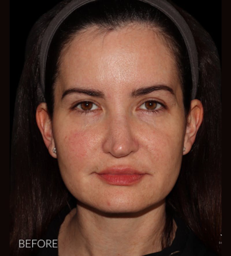 Facelift Before & After Gallery - Patient 121763167 - Image 1