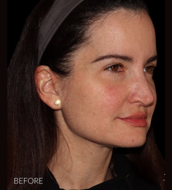 Facelift Before & After Gallery - Patient 121763167 - Image 7