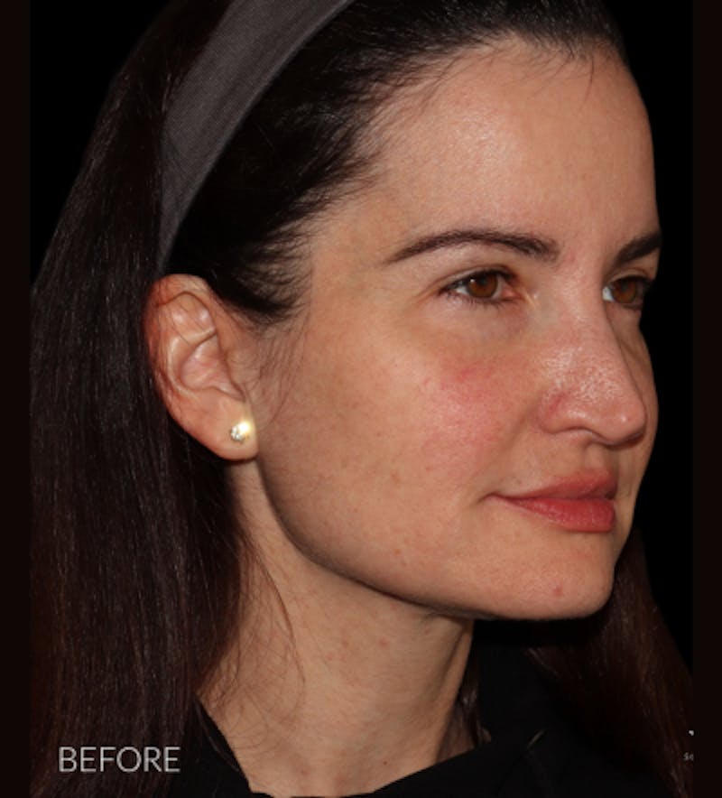 Facelift Before & After Gallery - Patient 121763167 - Image 7