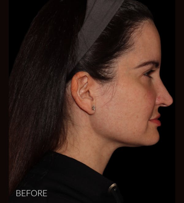 Facelift Before & After Gallery - Patient 121763167 - Image 3
