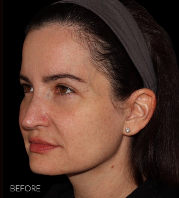 Facelift Before & After Gallery - Patient 121763167 - Image 5