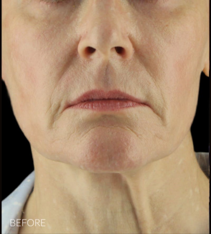 Facelift Before & After Gallery - Patient 121670066 - Image 1